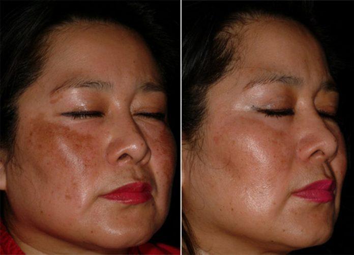 Thường xuyên sử dụng niacinamide có thể giúp làm giảm sắc tố da. (Nguồn: Internet).