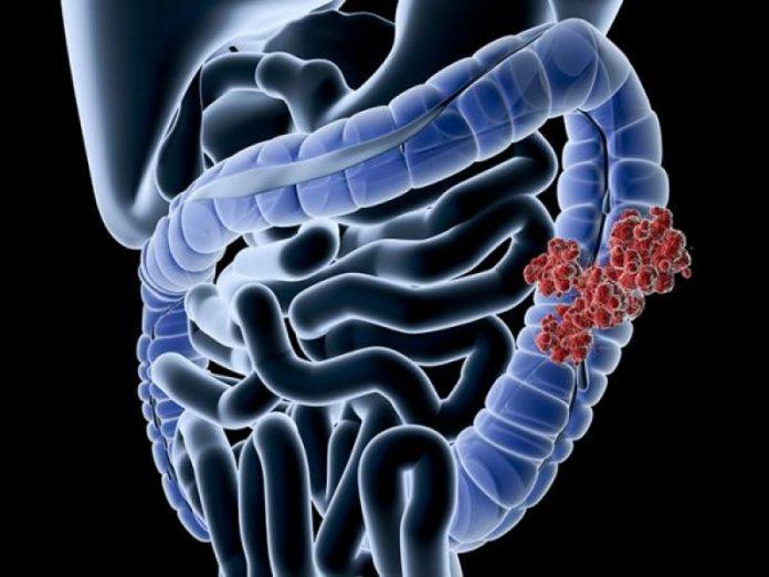 Bệnh Crohn gây viêm và tổn thương niêm mạc đường tiêu hóa nặng nề (Ảnh: Internet).