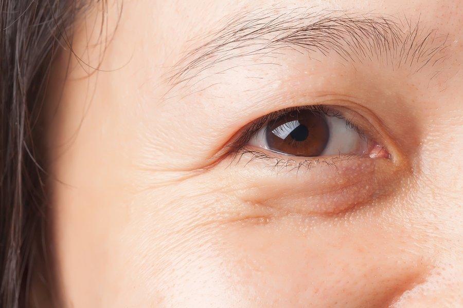 Bọng mắt thường xuất hiện ở những người có tuổi do quá trình lão hóa (Ảnh: Internet).