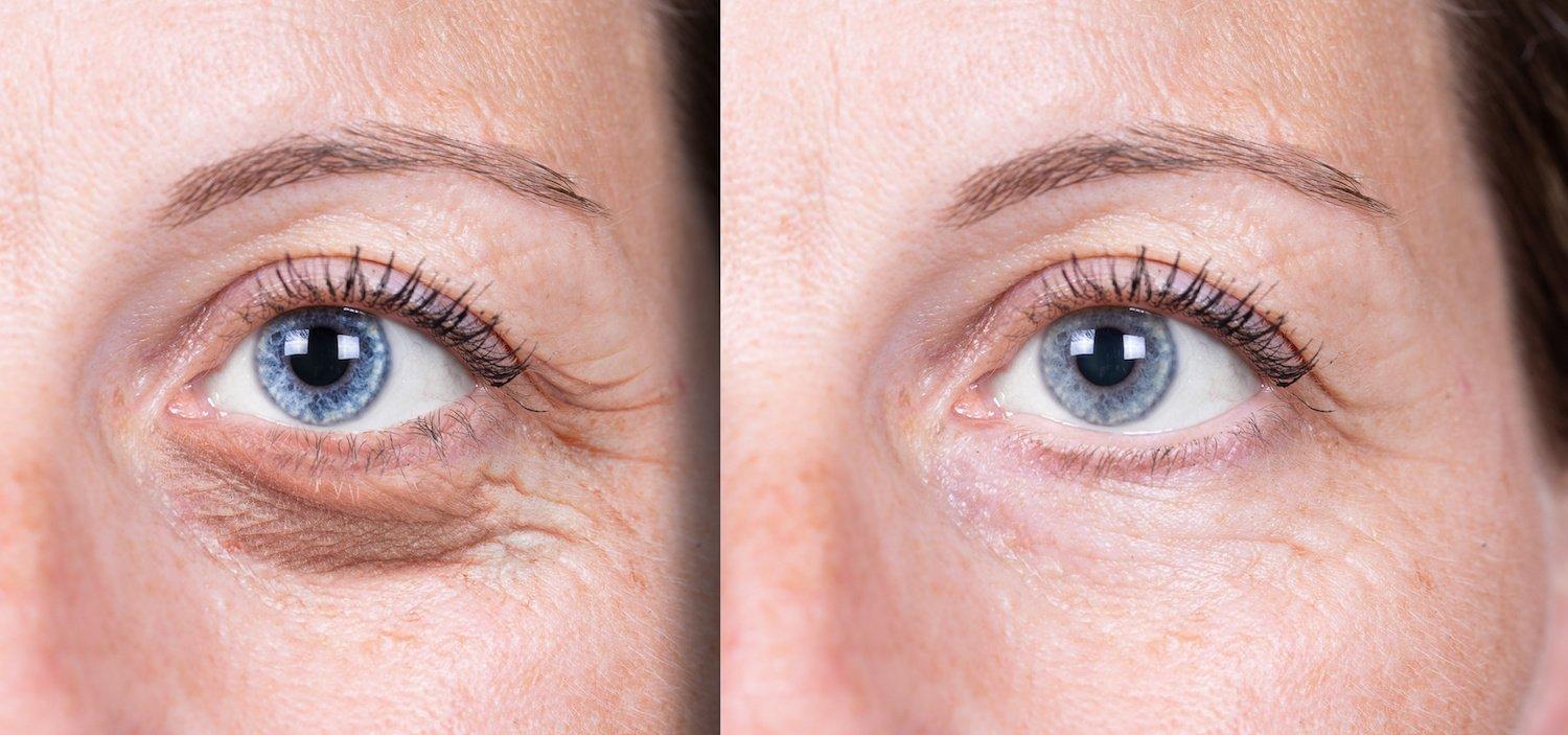 Hiệu quả của phương pháp dùng laser loại bỏ bọng mắt (Ảnh: Internet).