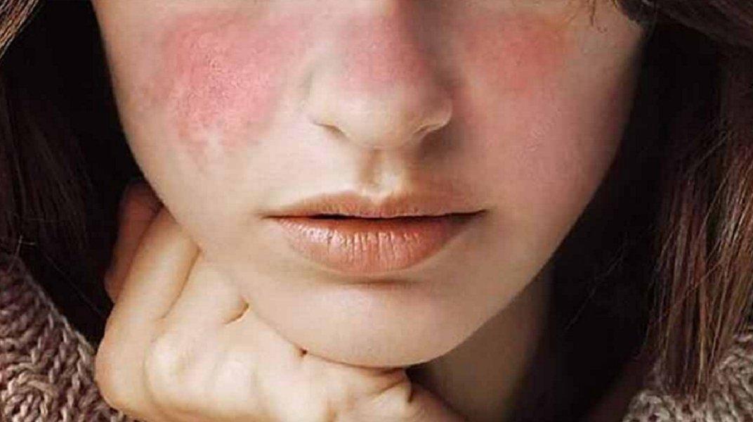Sử dụng nhiều kem chống nắng cùng lúc trên một vùng da có thể gây ra kích ứng (ảnh: internet)