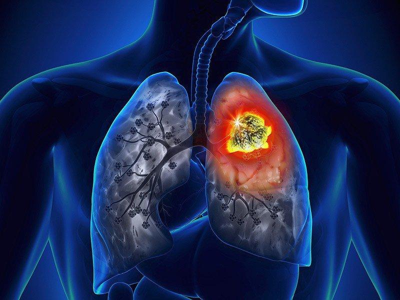 Ung thư phổi có thể xảy ra ở cả những người không hút thuốc (Ảnh: Internet).