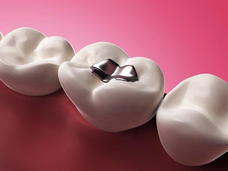 Trám răng bằng bạc có làm tăng nguy cơ mắc bệnh? (Ảnh: Internet).