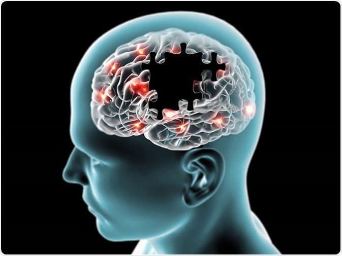 Bệnh Alzheimer "ăn mòn" bộ não dần dần (Ảnh: Internet).