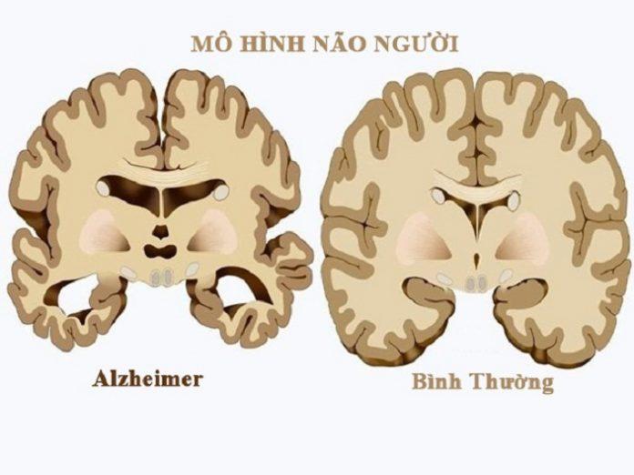Bệnh Alzheimer làm các tế bào não chết dần và não teo nhỏ lại (Ảnh: Internet).