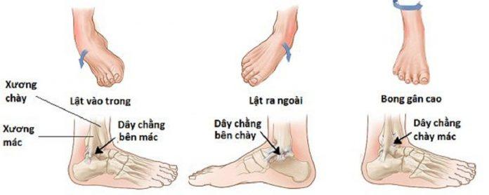 Có nhiều kiểu chấn thương mắt cá chân khác nhau (Ảnh: Internet).