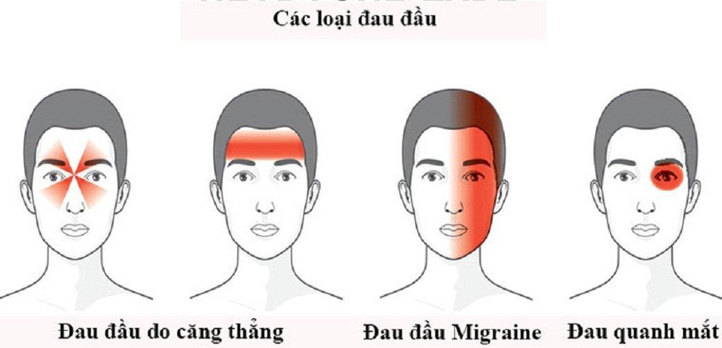 Một vài loại đau đầu khác nhau (Ảnh: Internet).