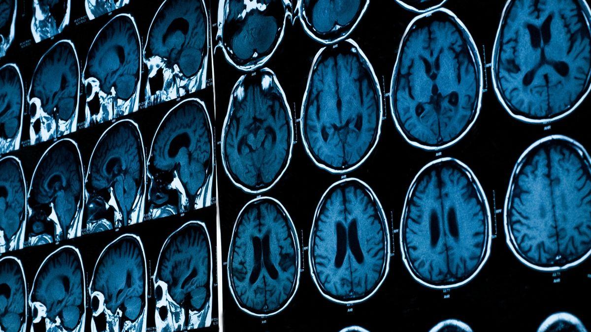 Chụp phim CT scan giúp loại trừ các nguyên nhân khác gây đau đầu (Ảnh: Internet).