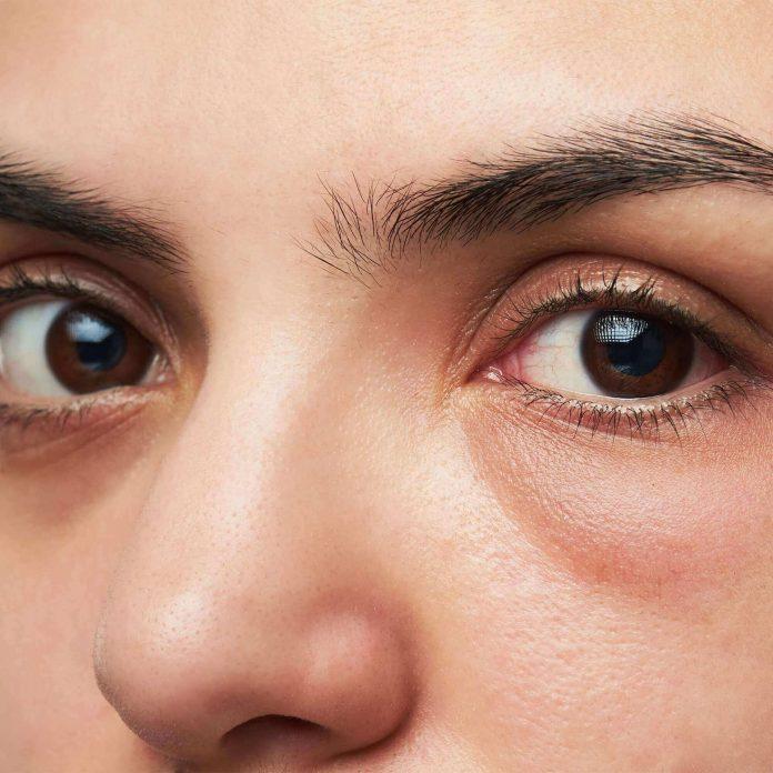 Vùng da dưới mắt là nơi đầu tiên xuất hiện những dấu hiệu lão hóa sớm trên da (Nguồn: Internet).