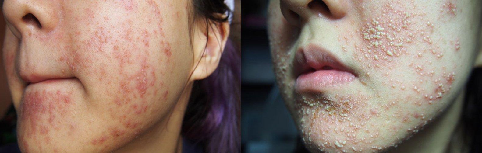 Vào giai đoạn cuối, da bắt đầu bùng phát mụn nghiêm trọng có thể là mụn viêm lẫn mụn bọc (Nguồn: Internet).