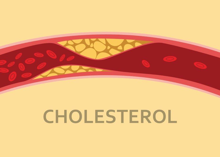 Cholesterol tích tụ làm xơ vữa động mạch và hẹp lòng mạch (Ảnh: Internet).