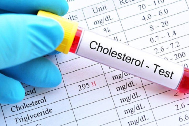 Xét nghiệm cholesterol máu (Ảnh: Internet).