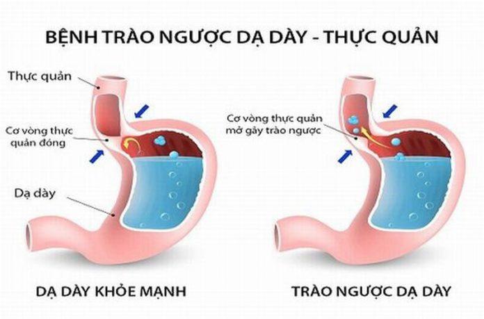 Thức ăn trong dạ dày bị trào ngược lên thực quản (Ảnh: Internet).