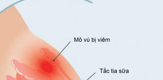 Tắc tia sữa gây ra áp xe vú