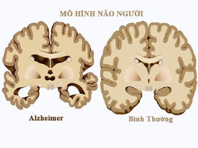 Bệnh Alzheimer làm "teo não" và mất dần trí nhớ (Ảnh: Internet).