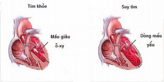 Tim bị suy không thể bơm máu đáp ứng nhu cầu của cơ thể (Ảnh: Internet).