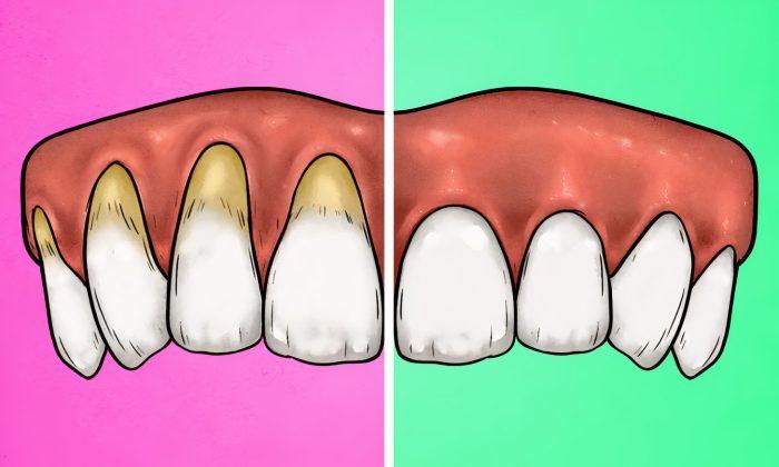 Tụt lợi là một trong những dấu hiệu cho thấy bạn đang đánh răng quá mạnh đấy (Ảnh: Internet).