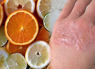 Viêm da do thực vật là gì? Có nguy hiểm cho làn da hay không?