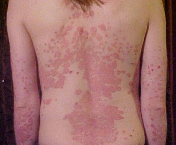 Vảy nến có thể xuất hiện ở nhiều vùng da khác nhau trên khắp cơ thể (Ảnh: Internet).