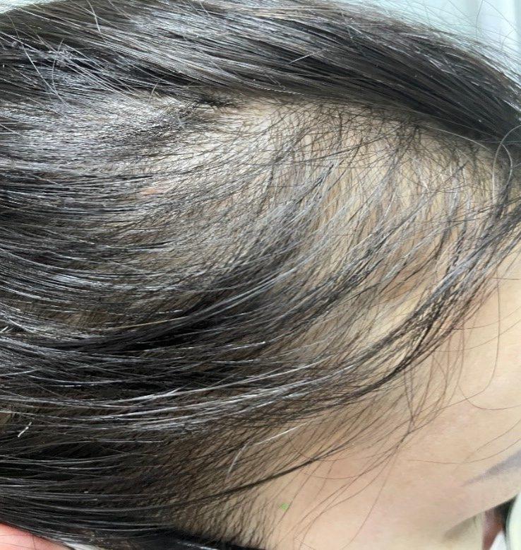 Tại sao tóc bị rụng nhiều và 3 các phương pháp trị rụng tóc
