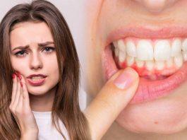 Chảy máu chân răng do nguyên nhân gì? Đừng chủ quan với những bệnh nguy hiểm tiềm ẩn!