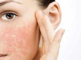 Cách chăm sóc cho da nhạy cảm dễ nổi mụn một cách an toàn, tránh kích ứng Da kích ứng, cháy nắng thường xuất hiện mẩn đỏ, ngứa rát (Ảnh: Internet).