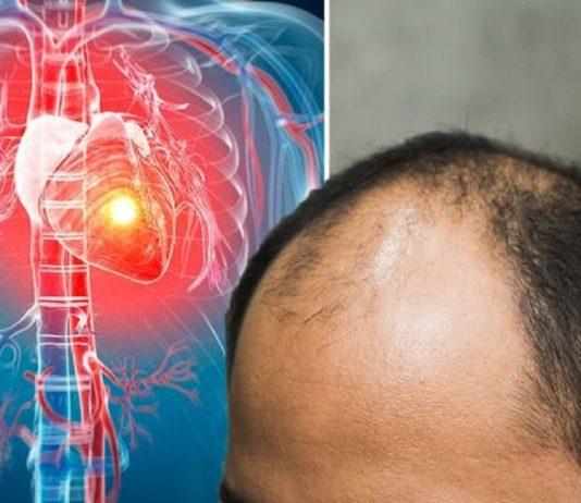 Hói đầu và tóc bạc sớm có thể là yếu tố nguy cơ mắc bệnh tim mạch – và nguy cơ rất cao!
