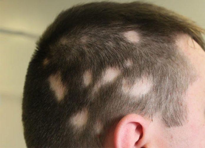Tóc rụng từng mảng là triệu chứng không hiếm gặp ở nam giới (Ảnh: Internet).