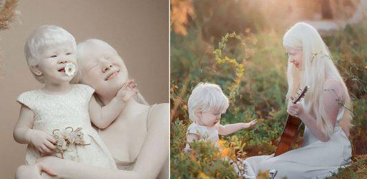 Bạch tạng là gì? Tại sao lại có người bạch tạng?