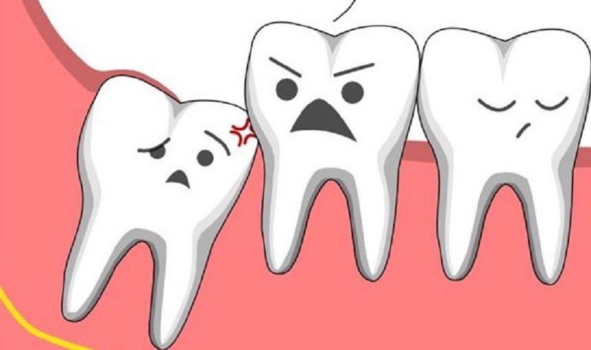 Những chiếc răng khôn mọc lệch gây nhiều phiền toái cho chúng ta (Ảnh: Internet).