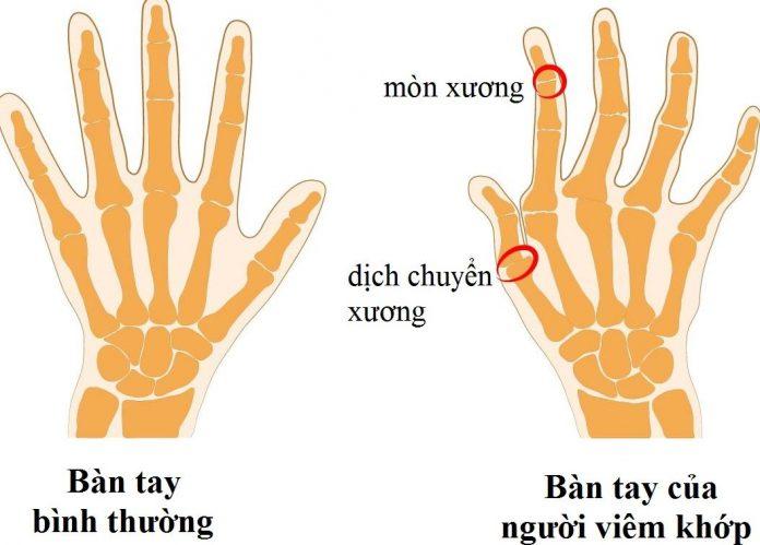 Sự khác biệt giữa tay người thường và người bị viêm khớp (Ảnh: Internet).