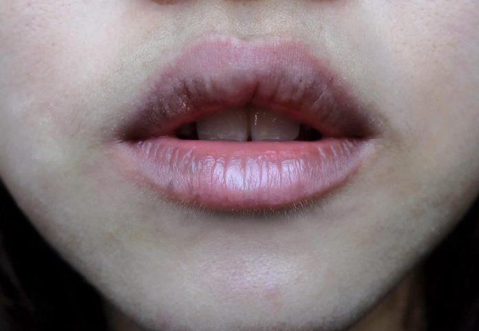 Thâm môi là do sự hình thành sắc tố melanin (Nguồn: Internet)