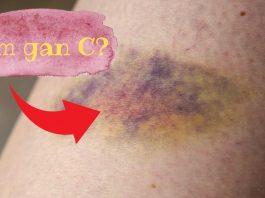 8 dấu hiệu trên da có thể là triệu chứng bệnh viêm gan C – Đừng chủ quan với những cảnh báo này!