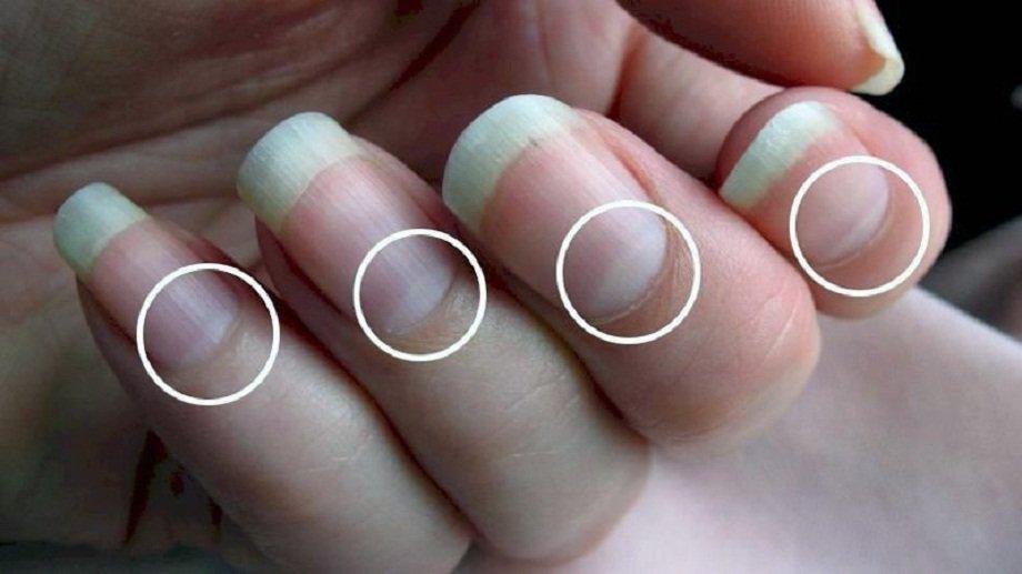 Những dấu hiệu bất thường ở móng tay có thể cảnh báo bệnh gì của cơ thể? -  BlogAnChoi