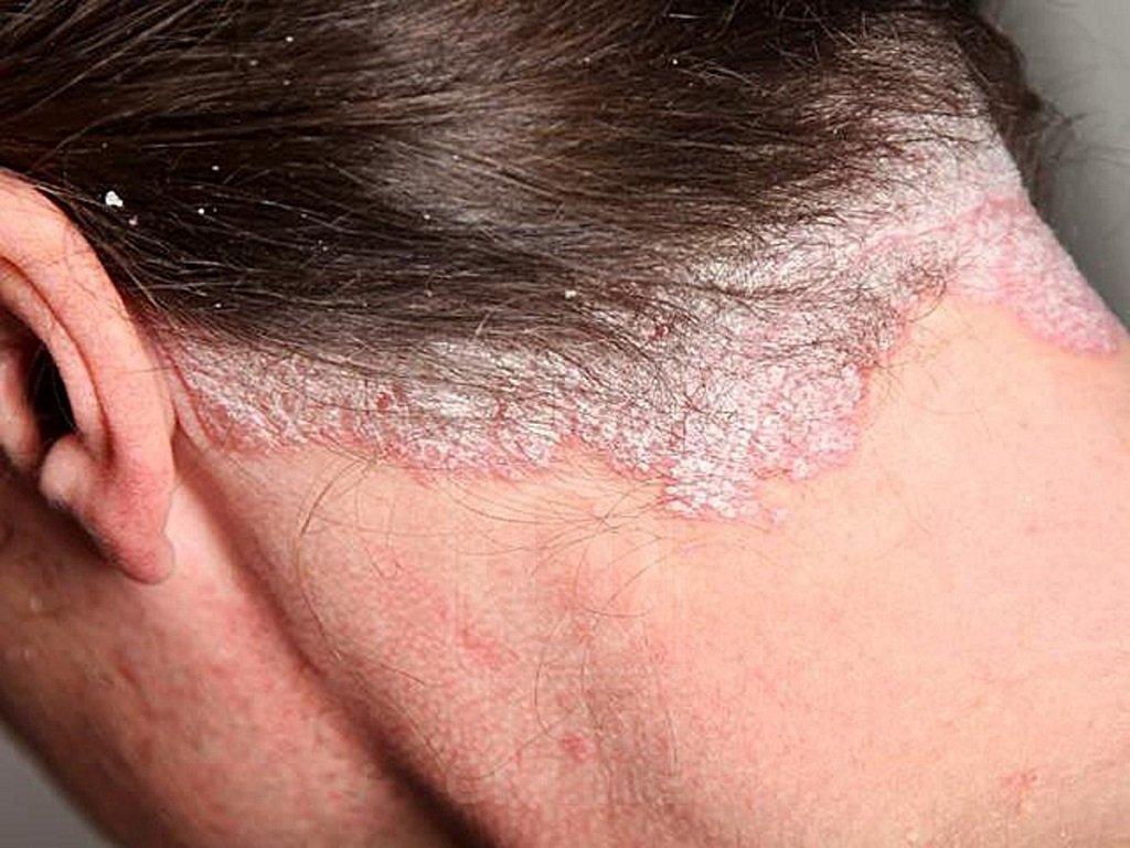 Bệnh vảy nến da đầu (Nguồn: Internet).
