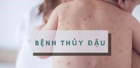 Người mắc bệnh thủy đậu nên ăn gì và tránh ăn gì để bệnh mau khỏi hơn? Bệnh thủy đậu