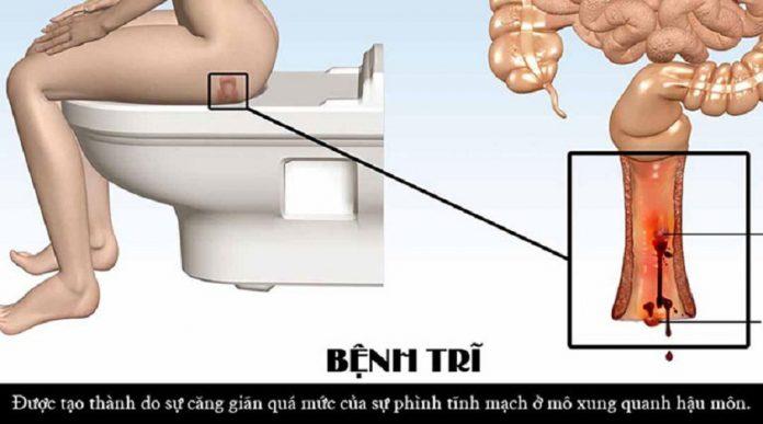 Bệnh trĩ có thể gây chảy máu khi đại tiện (Ảnh: Internet).