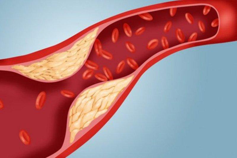 Tăng mỡ máu có thể làm xơ vữa động mạch và hẹp mạch máu (Ảnh: Internet).