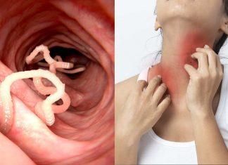 Ngứa là một dấu hiệu cơ thể đang bị nhiễm ký sinh trùng (Nguồn: Internet).