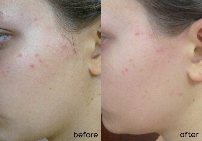 Trước và sau khi sử dụng kem dưỡng SVR SEBIACLEAR Mat + Pores