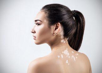 Bệnh lang ben là bệnh gì ? Cách phòng ngừa và điều trị như thế nào?