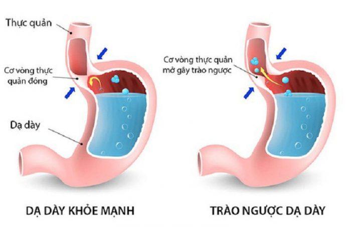 Nấc kéo dài có thể gây trào ngược dạ dày thực quản (Ảnh: Internet).