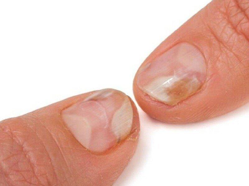 Móng bị nấm (Nguồn: Internet)