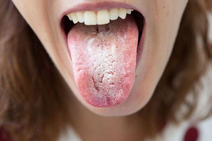 Nấm miệng có thể lan sang các bộ phận khác của cơ thể (Ảnh: Internet).