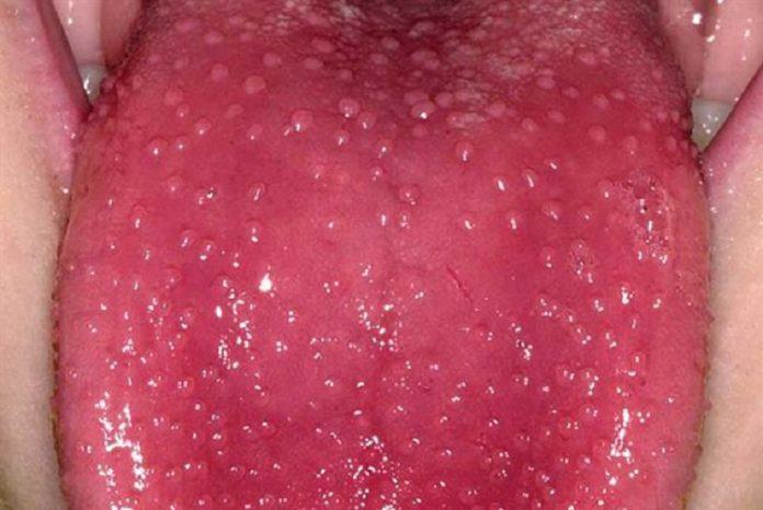Lưỡi đỏ có nhiều nốt to giống như quả dâu (Ảnh: Internet).