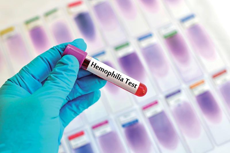 Xét nghiệm máu có thể biết chính xác bệnh hemophilia (Ảnh: Internet).
