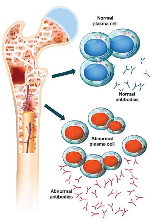 Myeloma ảnh hưởng đến các tế bào tạo kháng thể (Ảnh: Internet).
