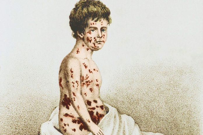 Hình vẽ minh họa người bị bệnh đậu mùa (Ảnh: Internet).