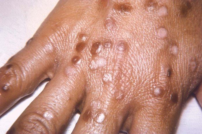 Tổn thương da của bệnh đậu mùa (Ảnh: Internet).