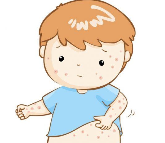 Bệnh đậu mùa – Nỗi kinh hoàng một thời liệu có còn tồn tại?